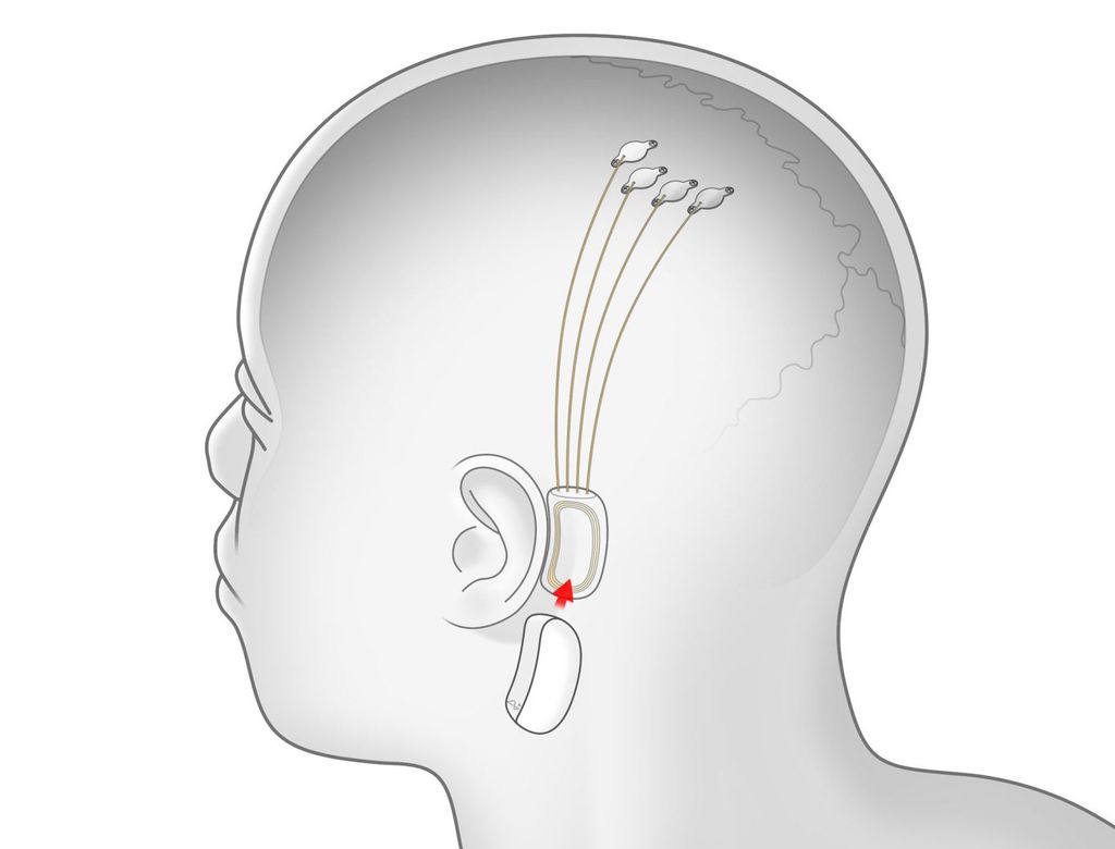 desenho mostrando chip da Neuralink no cerébro de um humano