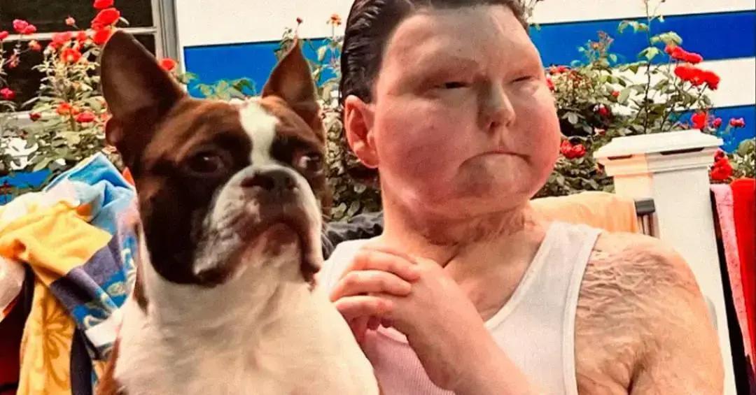 Primeiro homem a receber transplante de rosto e mãos fala sobre recuperação da independência