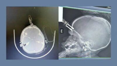 Lacunas na regulamentação de dispositivos eletrônicos em cirurgias pediátricas no Brasil